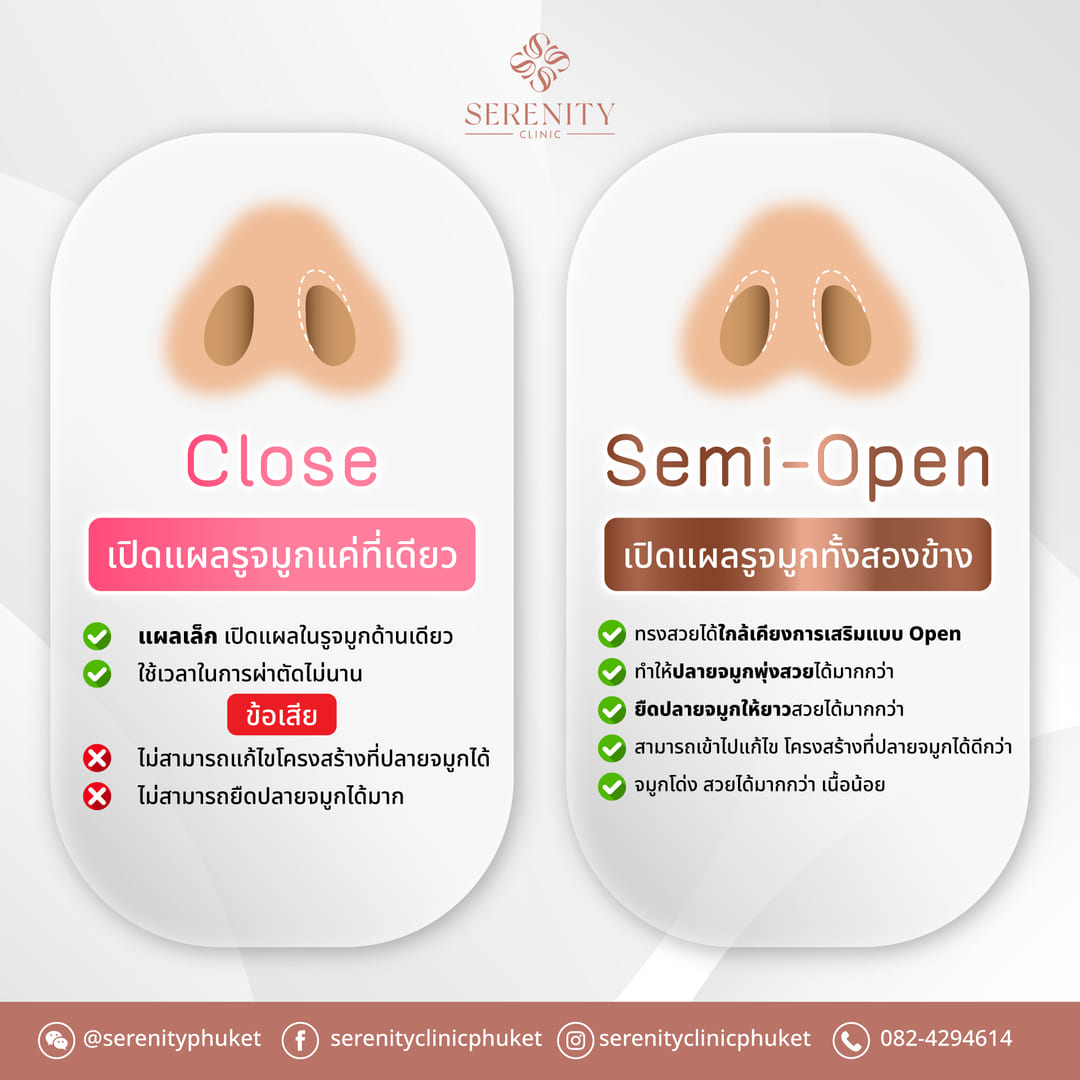 เปรียบเทียบการเสริมจมูกเทคนิค Close กับ Semi-Open ว่าเปิดแผลต่างกันอย่างไร